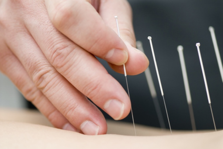 Akupunkturbehandlung Bei Hws Beschwerden
